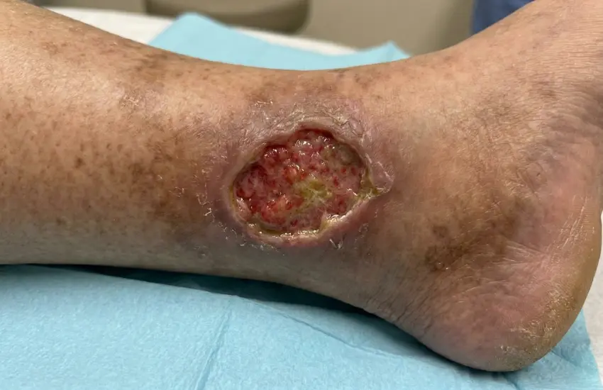 Leg Ulcer Conditions