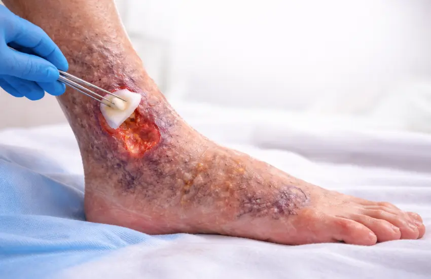 Leg Ulcer Treatment
