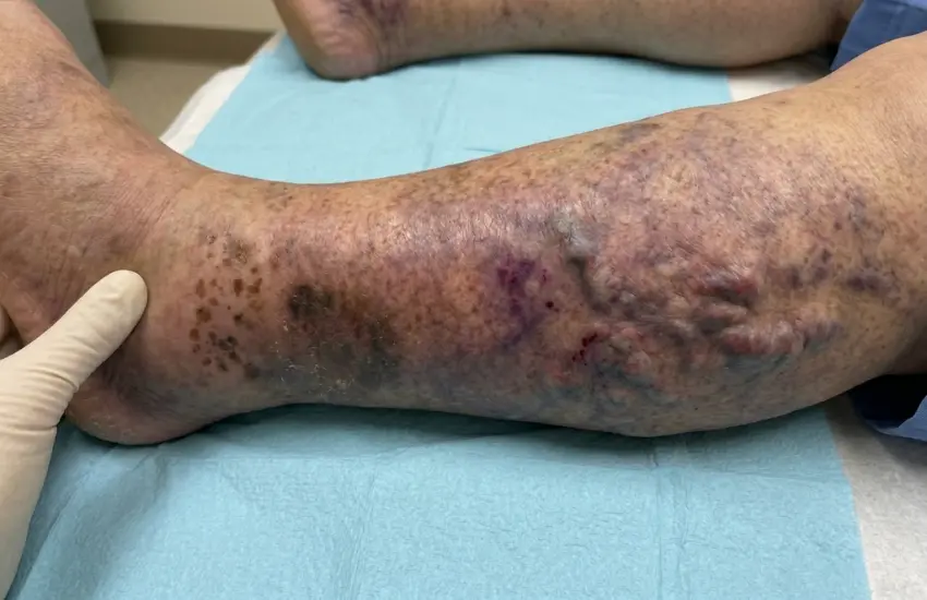 Vein Thrombosis Conditions